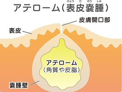 粉瘤(アテローム)の定義とは