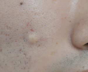 右頬の粉瘤(良性の皮膚腫瘍)