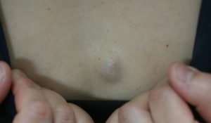 前胸部粉瘤(良性の皮膚腫瘍)