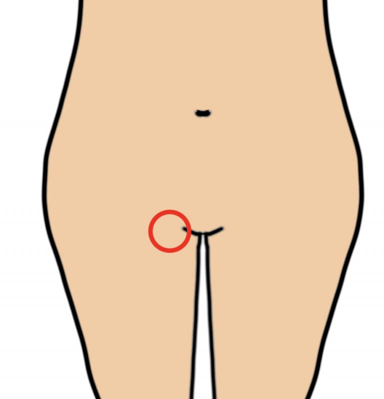 女性の足の付け根（鼠径部、股）の粉瘤による痛み 女性形成外科専門医による手術 大阪梅田形成外科粉瘤クリニック